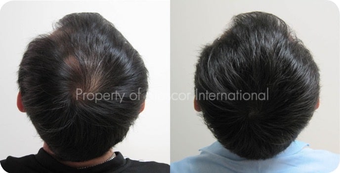 Male back of scalp before and after a course of medically supervised treatment