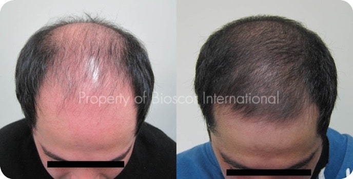 Male hairline and crown before and after a course of medically supervised treatment