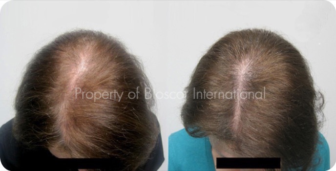 Female diffuse thinning before and after a course of medically supervised treatment