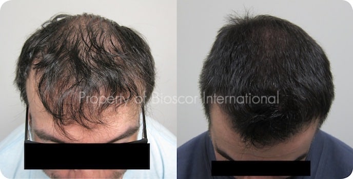 Male front scalp before and after a course of medically supervised treatment