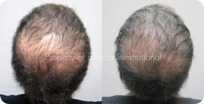 Female crown before and after a course of medically supervised treatment