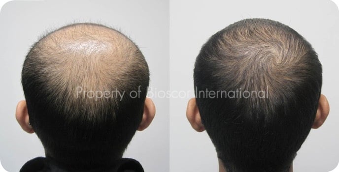 Male crown coverage before and after a course of medically supervised treatment