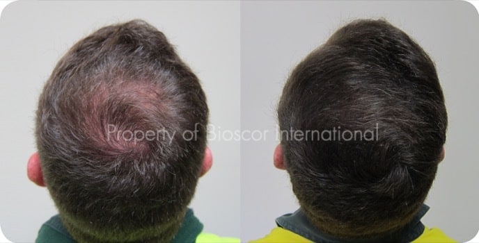 Male crown before and after a course of medically supervised treatment