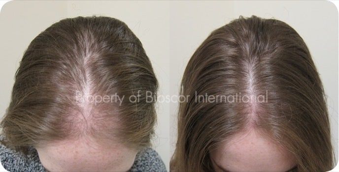 Female part line before and after a course of medically supervised treatment