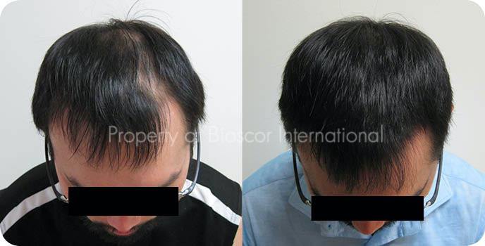 Male frontal scalp before and after a course of medically supervised treatment